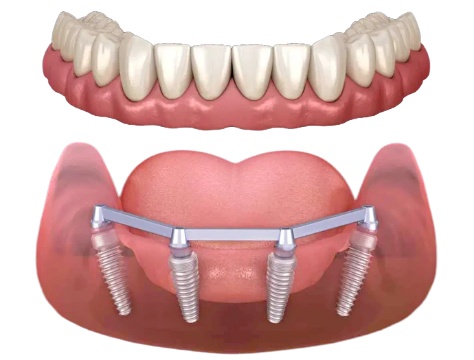 Full-Mouth Dental Implants Procedure in Lincoln, NE at Capital Dental Implant & Surgery Center