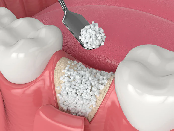 Dental Bone Grafting in Lincoln, NE at Capital Dental Implant & Oral Surgery Center