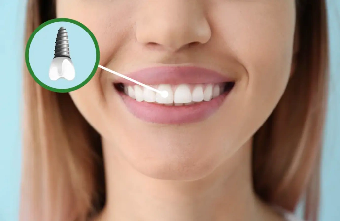 Dental Implant installed in Lincoln, NE at Capital Dental Implant & Oral Surgery Center