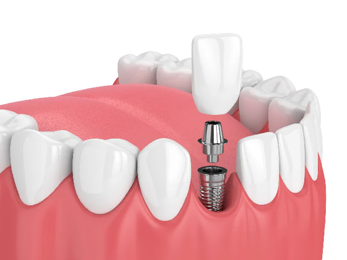 Dental Implant Procedure in Lincoln, NE at Capital Dental Implant & Surgery Center