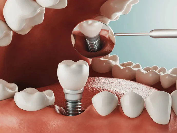 Dental implants in Lincoln, NE at Capital Dental Implant & Surgery Center