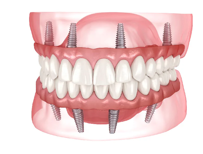 Full-Mouth Dental Implants in Lincoln, NE at Capital Dental Implant & Surgery Center