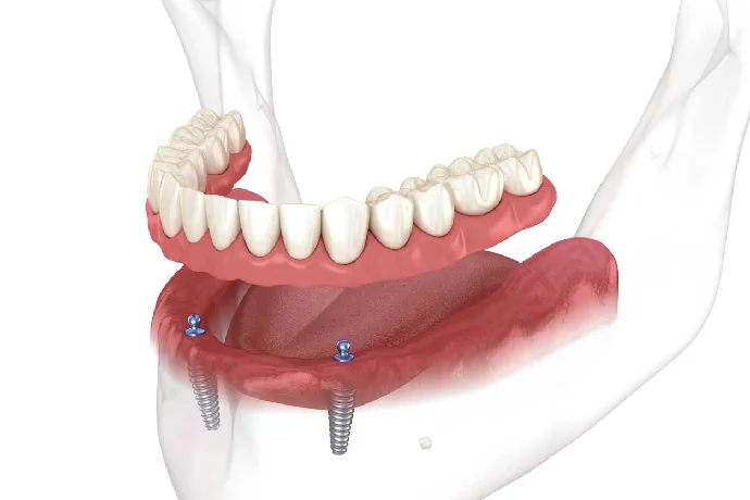 Implant supported dentures in Lincoln, NE a Capital Dental Implant & Oral Surgery Center