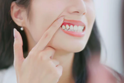 Irritated Gums in Lincoln, NE addressed at Capital Dental Implant & Surgery Center