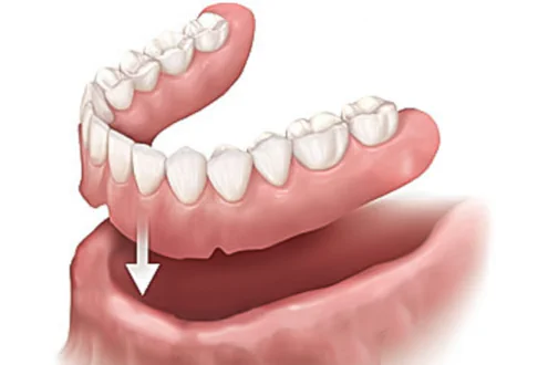 Slipping Dentures in Lincoln, NE addressed at Capital Dental Implant and Surgery Center